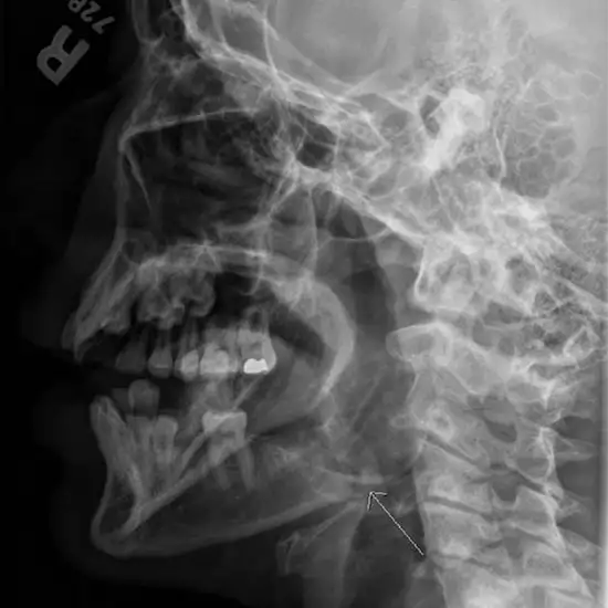 x-ray mandible left lateral oblique